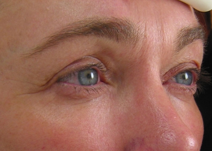 Ultherapy Augen Nachher Dr. Wallentin Wien