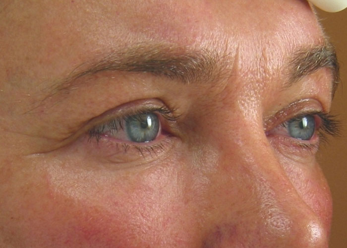 Ultherapy Augen Vorher Dr. Wallentin Wien